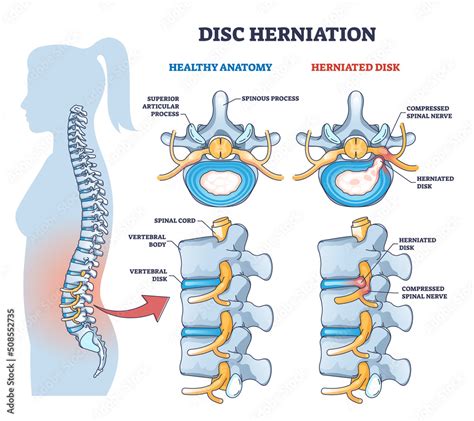 Sciatic nerve pathway illustration