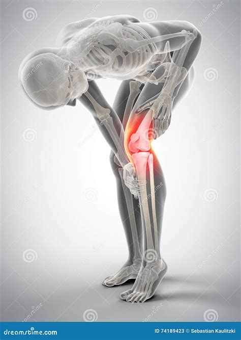 Knee pain stock illustration. Illustration of ligament - 74189423