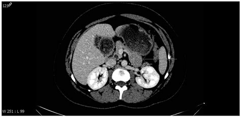 Perivascular Epithelioid Cell Tumor (PEComa) of the Pancreas in a ...
