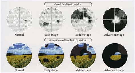 Best Glaucoma Hospital in Chandigarh | Grover Eye Hospital