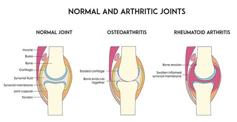 Rheumatoid Arthritis Treatment Kerala | Knee Pain Treatment India