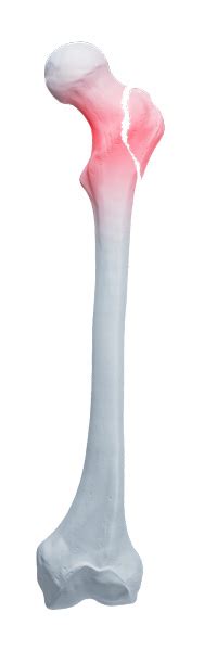 Knochenfrakturen – Krankheitsbilder - Bort