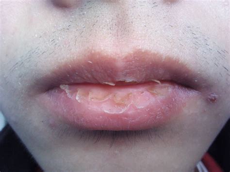 春天嘴唇常干裂脱皮，是因为缺水？可能是唇炎|唇炎|脱皮|唇部_新浪新闻