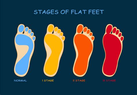 How Does Flat Feet Happen at Darren Pennington blog