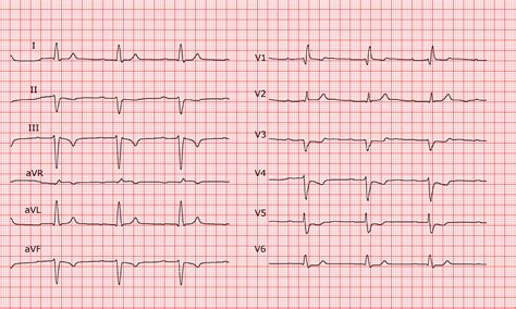 [Cardio-FR] Bifaszikulärer Block mit AV-Block I° (linksanteriorer Hemiblock, Rechtsschenkelblock).