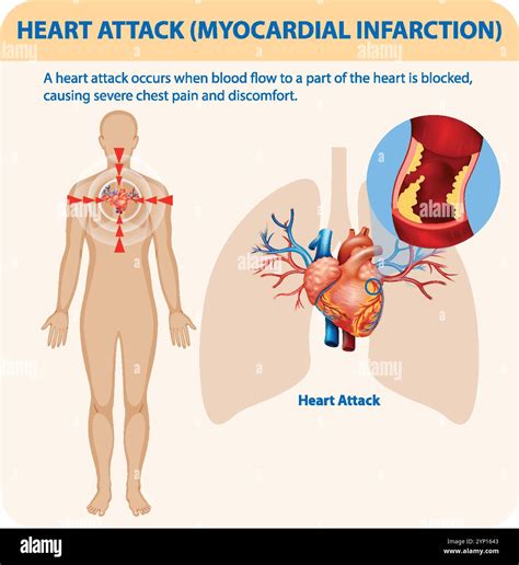 Illustration of heart attack symptoms and causes Stock Vector Image & Art - Alamy