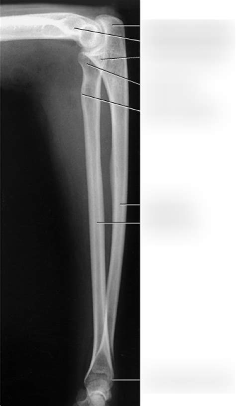 Image result for Contralateral Forearm