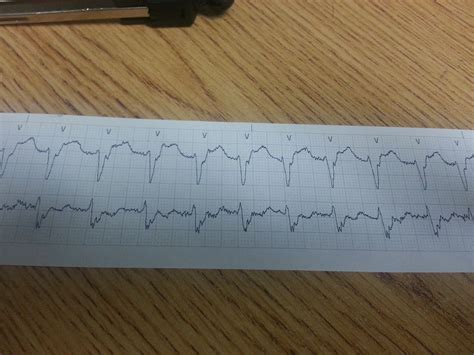 SVT with aberrancy or VT? : r/EKG