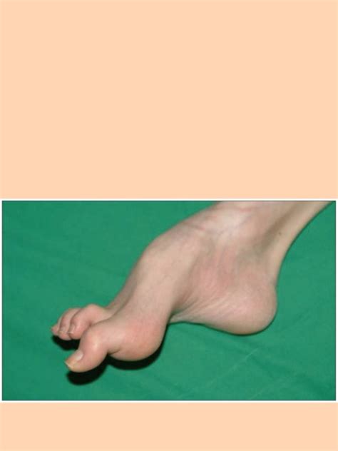 Iron deficiency | Times of India