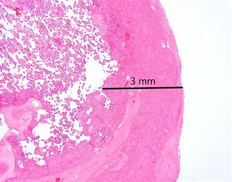 What Is A Maternal Floor Infarction at James Daulton blog