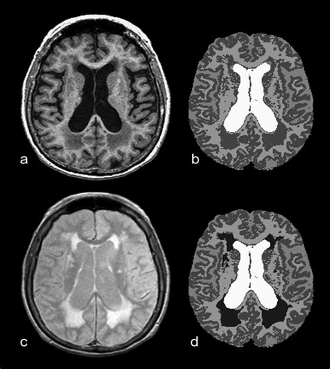 Understanding White Matter Disease | Stroke