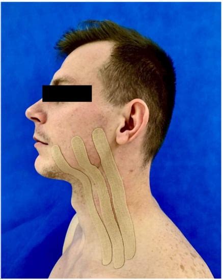 The Impact of Using Kinesio Tape on Non-Infectious Complications after ...