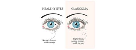 Early signs of Glaucoma!