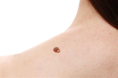 Este Es El Significado De Las Verrugas En El Cuello Bioguia