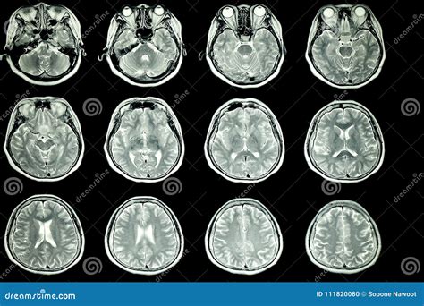 Mri Scan Brain Normal