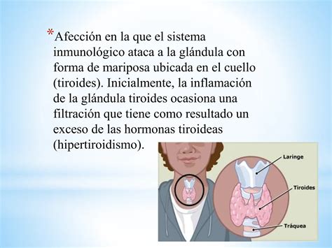 TIROIDITIS HASHIMOTO.pptx