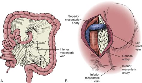 Image result for Open Nephrectomy Procedure