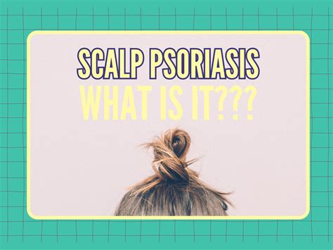 Scalp Psoriasis SOS: The Causes, Symptoms, and the Miracle Oil You Need ...