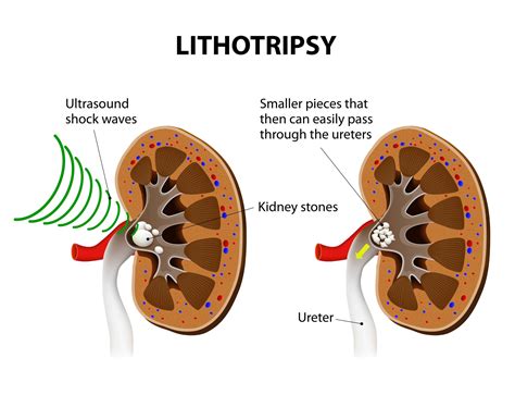 CULLS Laser Lithotripsy For Kidney Stones | North Texas | UPNT