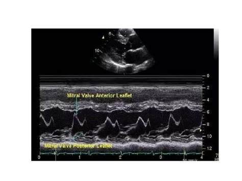 Mitral stenosis Echocardiography | PPT
