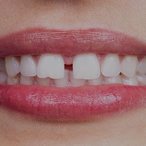 Smart Aligners