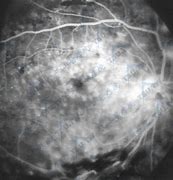 Image result for 视网膜病变