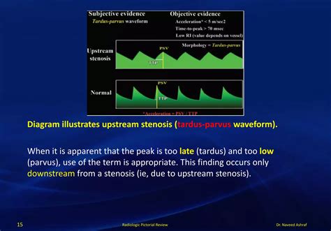 Doppler ultrasound in peripheral arterial disease | PDF