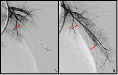 Chronisch thromboembolische pulmonale Hypertonie: moderne Therapiekonz ...