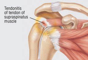 Tendonitis Guide: Causes, Symptoms and Treatment Options