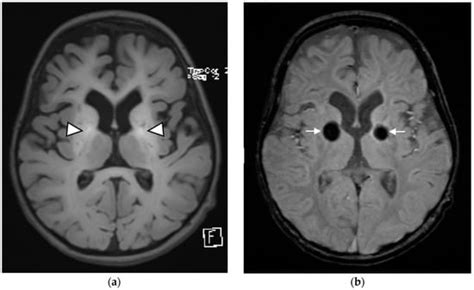 Hypermanganesemia with Dystonia Type 2: A Potentially Treatable ...