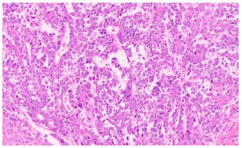 Update on the Pathology of Pediatric Liver Tumors: A Pictorial Review