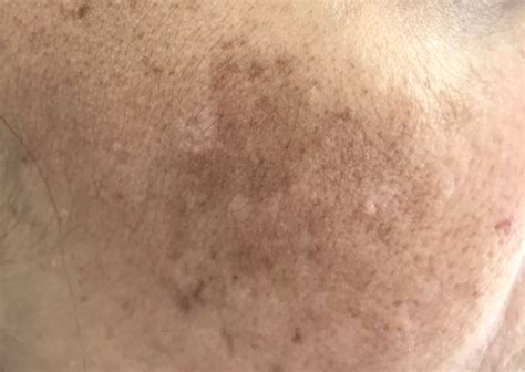 Hyperpigmentation: Causes and Treatment of Hyperpigmentation - The Pink ...