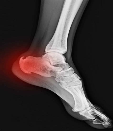Achilles Heel Bone Spur