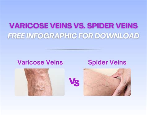 Here's Your Free Varicose Veins vs. Spider Veins Infographic