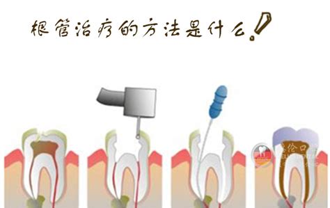 牙髓炎治疗要多少钱 - 牙周治疗 - 上海泰康拜博口腔医院