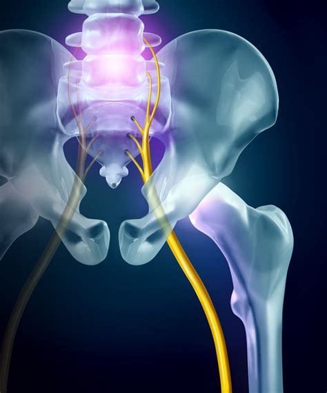 Relief of Sciatica Pain | Advanced Pain Management & Spine Specialists