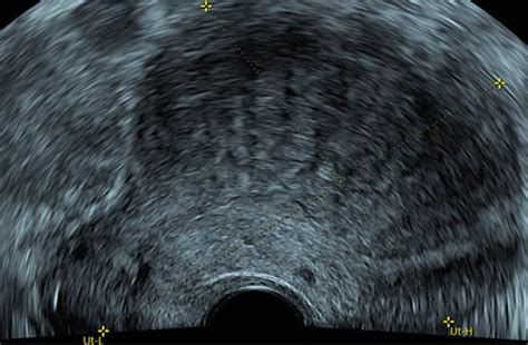 Differenzierte gynäkologische Sonografie: Adenomyose - Gynäkologie ...