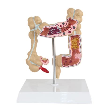 Colorectal Pathology Model Human Large Intestine Anatomy Model ...