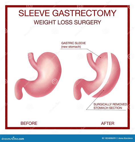 Vertical Sleeve Gastrectomy. Weight Loss Surgery .Anatomical. Stock Vector - Illustration of ...