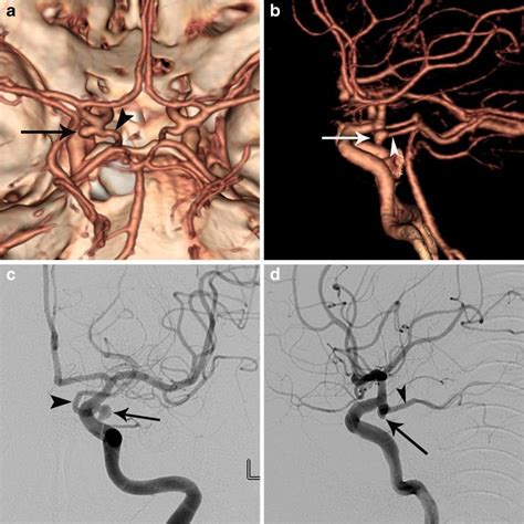 Posterior Communicating Artery Aneurysm Neurointervention