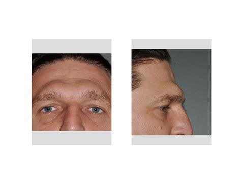Prominent Brow Ridge Reduction