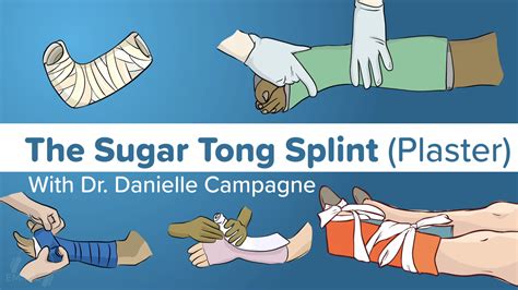 Reverse Sugar Tong Splint