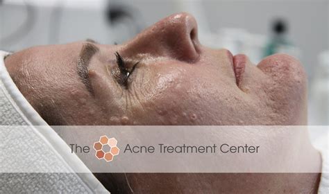 Before/After Patient Photos | Hyperpigmentation, Inflamed Acne | The Acne Treatment Center