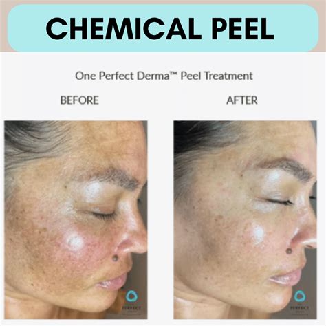 Rejuvenate Your Skin with Our Chemical Peel Procedure at Estea Laser and Cosmetic Center - Estea ...