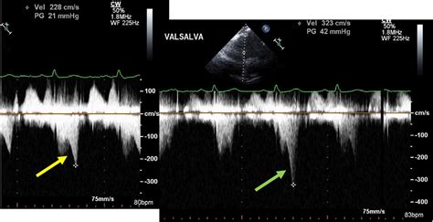 Left ventricular cavity obliteration: Mechanism of the intracavitary gradient and ...