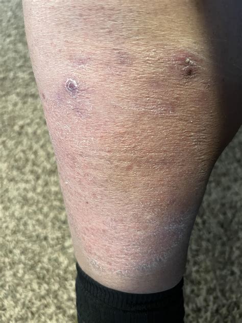 Rash on lower leg itches from time to time and creates pimple like spots that are really itchy ...