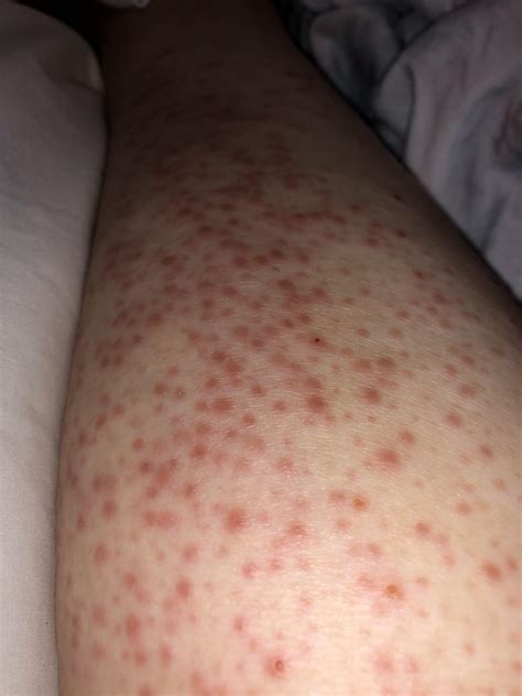 Rash On Thighs Pregnant at Juan Zuniga blog