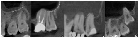 Panoramic Radiography vs. CBCT in the Evaluation of the Maxillary Third ...
