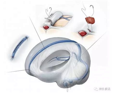 硬脑膜静脉窦损伤| The Neurosurgical Atlas系列