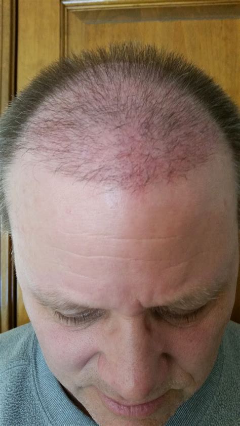 FUE Hair Transplant After 1 Week | Marc Dauer, MD Hair Transplant ...